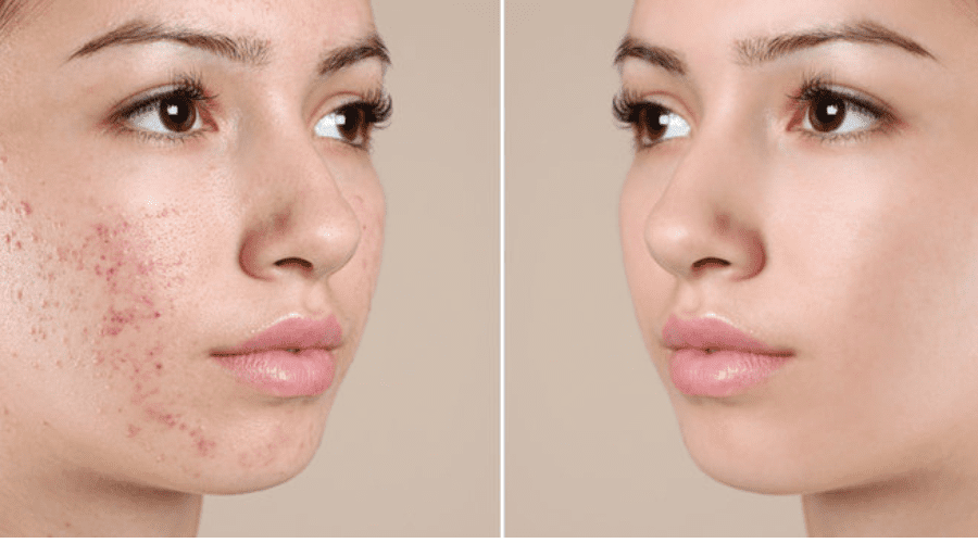 Skin Retouching